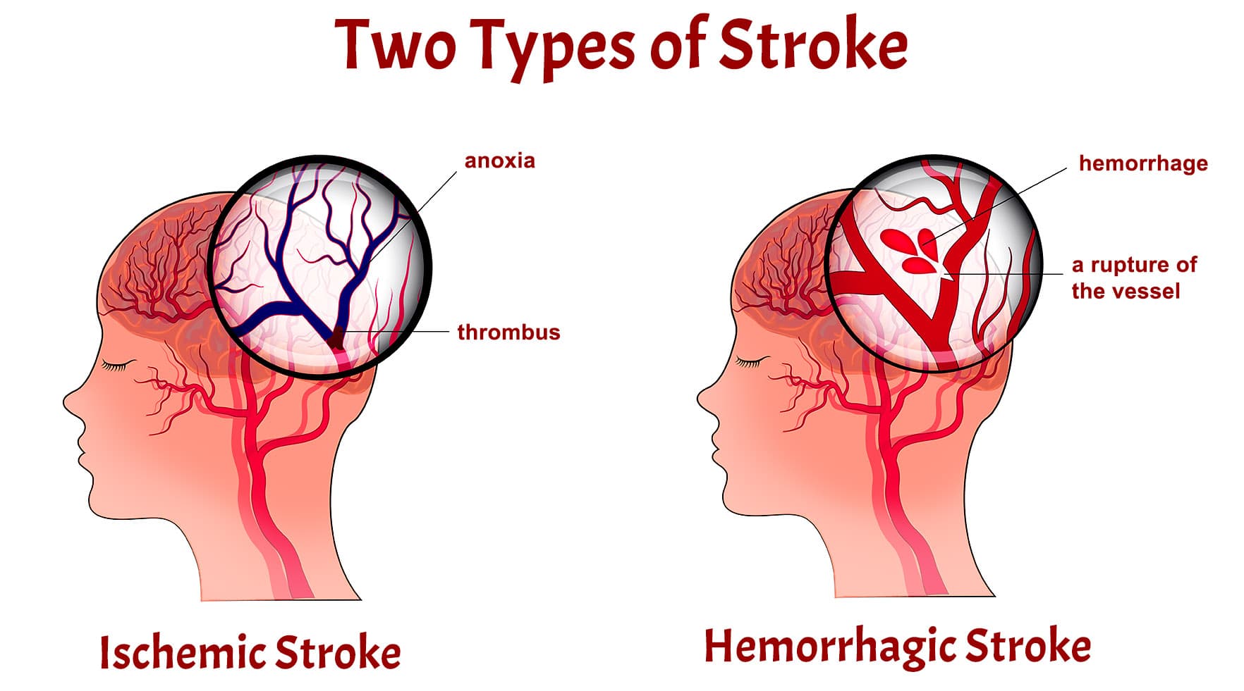 2 types of strokes