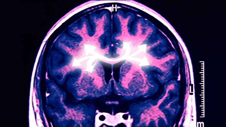 Corpus Callosum